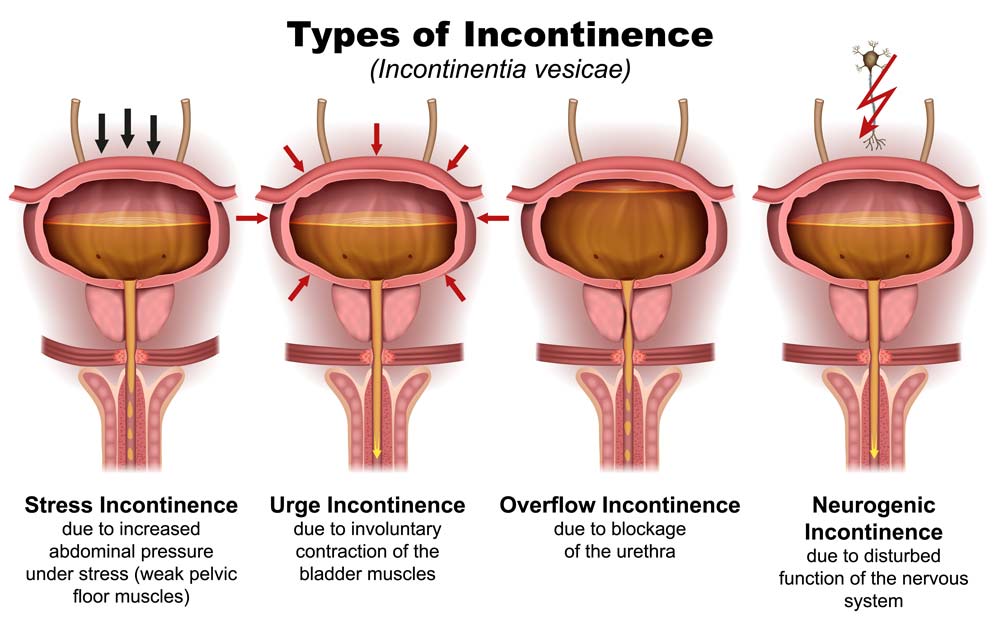 Types-of-Incontinence
