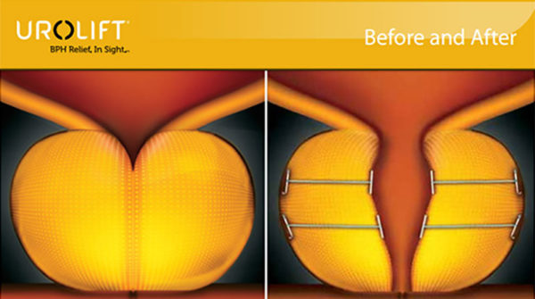 Barrigel Spacer  Minimize Prostate Radiation Side Effects