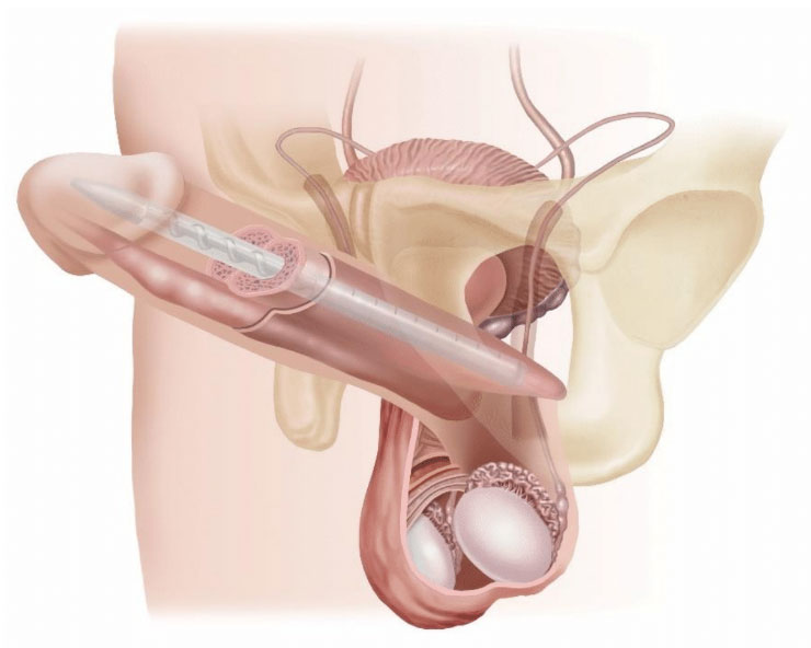 Penile-Implant-14