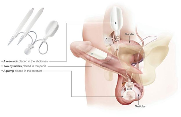 Penile-Implant-15