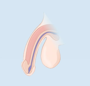 Penile-Implant-2