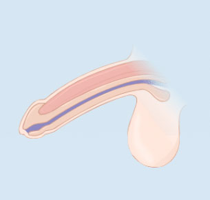 Penile-Implant-3