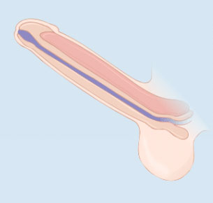 Penile-Implant-4