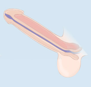 Penile-Implant-6
