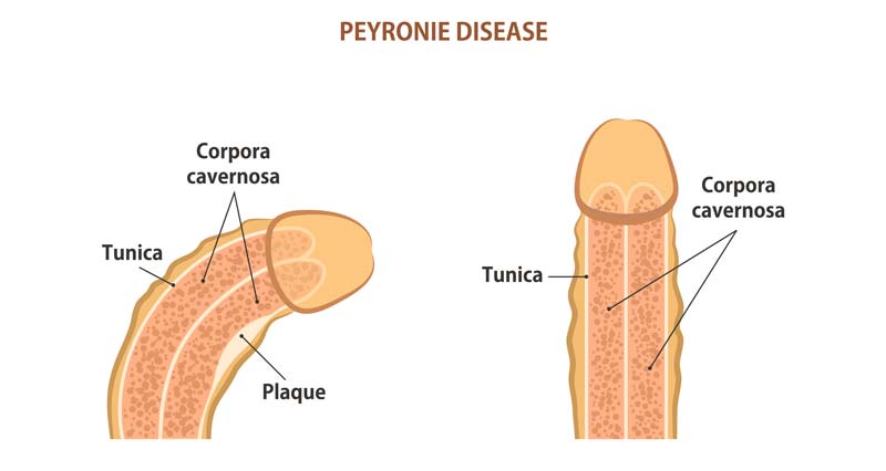 In de naam schaamte De kerk Peyronie's Disease: Causes, Diagnosis & Treatment