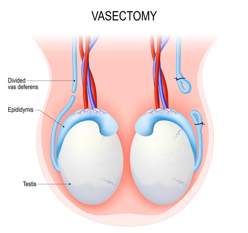 Vasectomy: Causes, Diagnosis & Treatment
